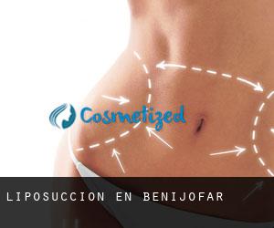 Liposucción en Benijófar