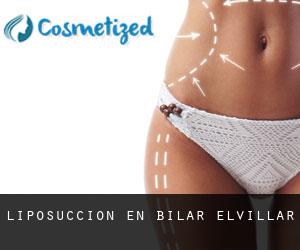 Liposucción en Bilar / Elvillar Liposucción en Bilar / Elvillar