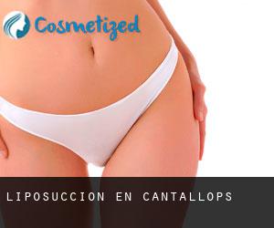 Liposucción en Cantallops