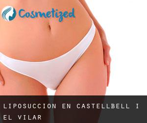 Liposucción en Castellbell i el Vilar