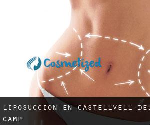 Liposucción en Castellvell del Camp