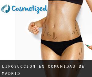 Liposucción en Comunidad de Madrid Liposucción en Comunidad de Madrid
