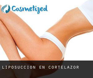 Liposucción en Cortelazor Liposucción en Cortelazor