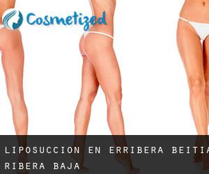 Liposucción en Erribera Beitia / Ribera Baja