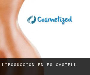 Liposucción en Es Castell