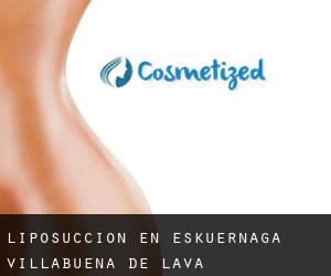 Liposucción en Eskuernaga / Villabuena de Álava Liposucción en Eskuernaga / Villabuena de Álava