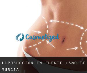 Liposucción en Fuente Álamo de Murcia Liposucción en Fuente Álamo de Murcia