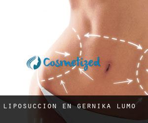 Liposucción en Gernika-Lumo