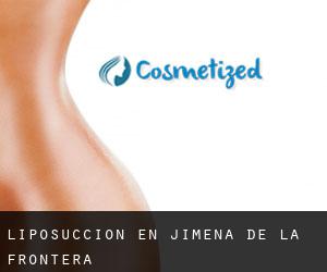 Liposucción en Jimena de la Frontera Liposucción en Jimena de la Frontera