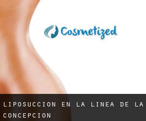 Liposucción en La Línea de la Concepción Liposucción en La Línea de la Concepción