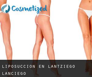 Liposucción en Lantziego / Lanciego