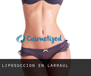 Liposucción en Larraul