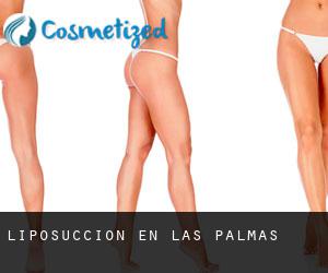 Liposucción en Las Palmas