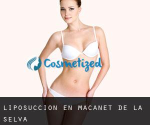 Liposucción en Maçanet de la Selva Liposucción en Maçanet de la Selva