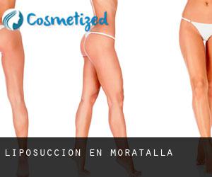 Liposucción en Moratalla Liposucción en Moratalla