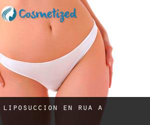 Liposucción en Rúa (A) Liposucción en Rúa (A)