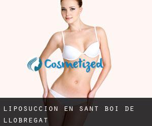 Liposucción en Sant Boi de Llobregat