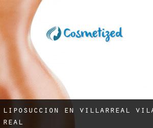 Liposucción en Villarreal / Vila-real