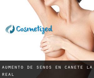 Aumento de Senos en Cañete la Real Aumento de Senos en Cañete la Real
