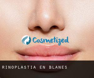 Rinoplastia en Blanes Rinoplastia en Blanes