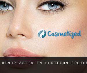 Rinoplastia en Corteconcepción